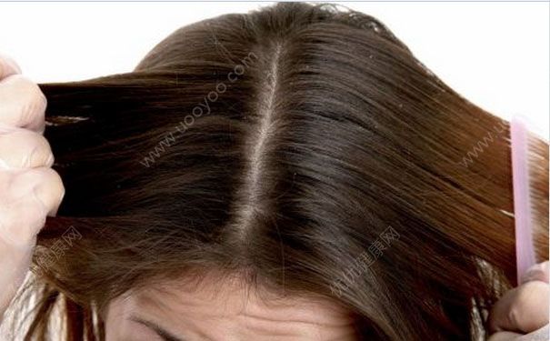 頭皮癢怎么辦？頭皮癢頭屑多怎么辦？(1)