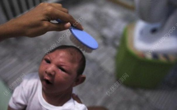 寨卡病毒怎么治好？寨卡病毒感染怎么治療有效？(4)