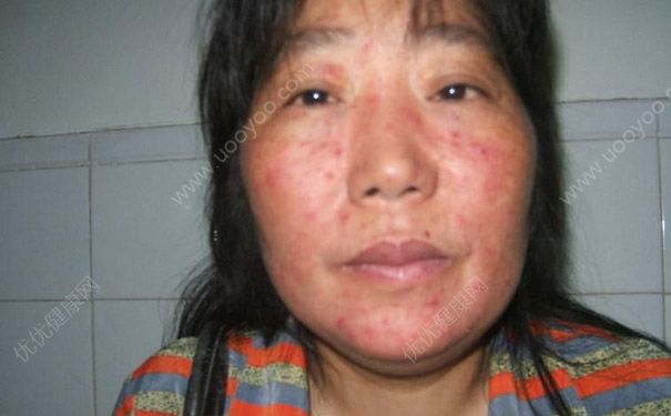 寨卡病毒致命嗎？寨卡病毒致死嗎？(1)