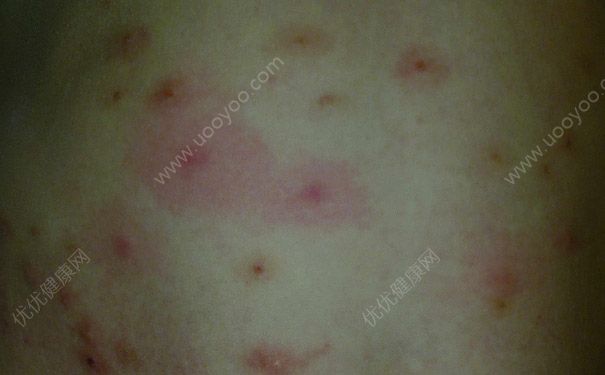 預(yù)防寨卡病毒方法有那些？怎樣預(yù)防寨卡病毒最有效？(6)