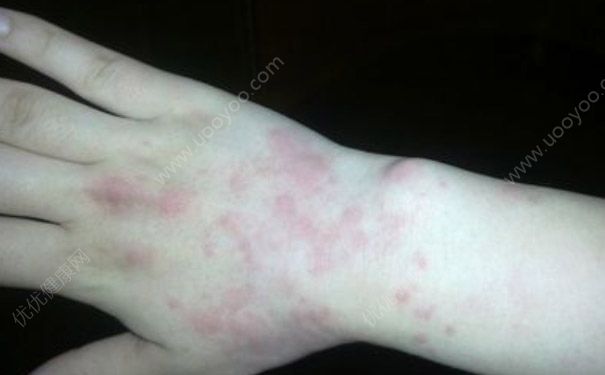 寨卡病毒能自愈嗎？感染寨卡病毒會自愈嗎？(1)