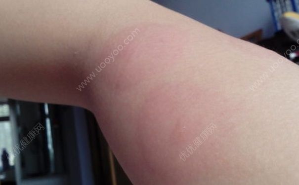 蕁麻疹是怎么引起的？蕁麻疹臨床表現(xiàn)(1)