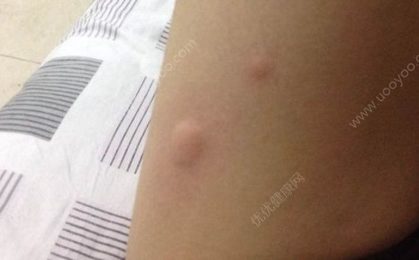 蕁麻疹是怎么引起的？蕁麻疹臨床表現(xiàn)(2)