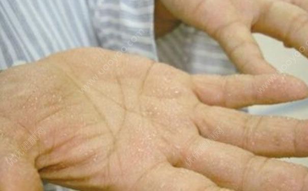 手腳多汗是什么原因？手腳多汗癥怎么根治？(1)