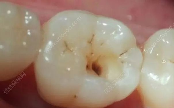 齲齒飲食上注意什么？齲齒吃什么食物比較好？(1)