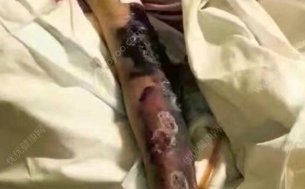 淋巴癌是怎么引起的？淋巴癌能治愈嗎？(3)