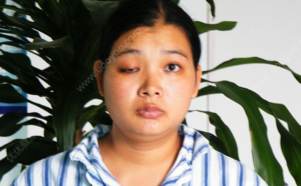 眼睛神經(jīng)麻痹怎么治療？眼睛神經(jīng)麻痹能治好嗎？(1)