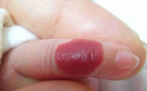 血管瘤吃什么好？血管瘤可以吃雞蛋嗎？(1)