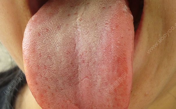 舌苔發(fā)白是什么原因？舌苔發(fā)白怎么調(diào)理？(1)