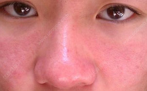 皮膚過(guò)敏臉腫了怎么辦？皮膚過(guò)敏治療小妙招(1)
