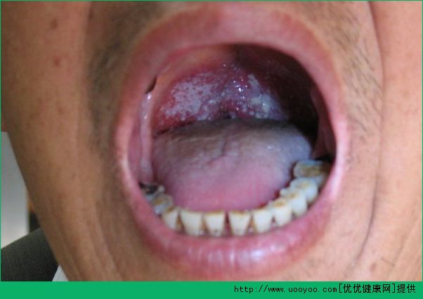 復(fù)發(fā)性口腔潰瘍的危害有哪些？經(jīng)常患口腔潰瘍有什么危害？(4)