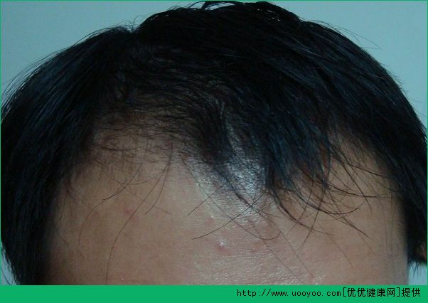 中年人為什么會掉頭發(fā)？中年掉頭發(fā)是什么原因？(1)