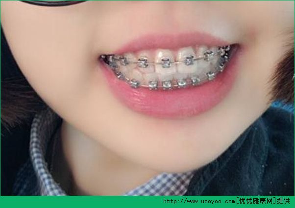帶牙套能改變臉型嗎？帶牙套后幾點(diǎn)注意事項(xiàng)(1)
