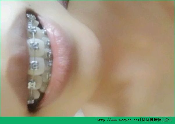 帶牙套能改變臉型嗎？帶牙套后幾點(diǎn)注意事項(xiàng)(4)