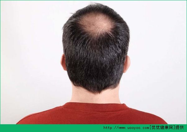 掉頭發(fā)嚴重怎么回事？如何防止掉發(fā)？(1)