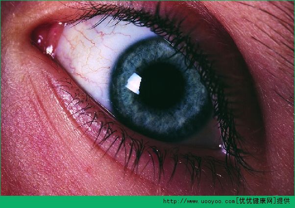 中午睡覺能帶隱形眼鏡嗎？睡覺帶隱形眼鏡有什么危害？(3)