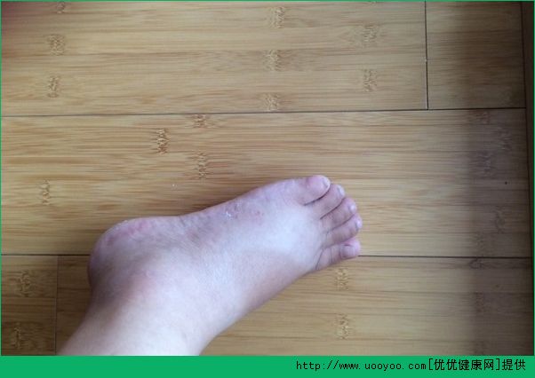 夏天腳腫是怎么回事？夏天腳腫怎么辦？(2)