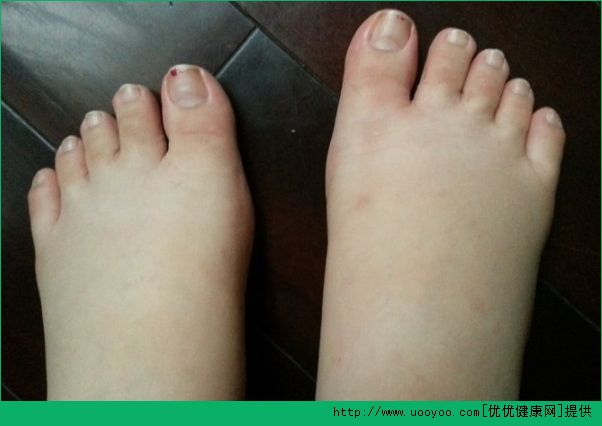 夏天腳腫是怎么回事？夏天腳腫怎么辦？(3)
