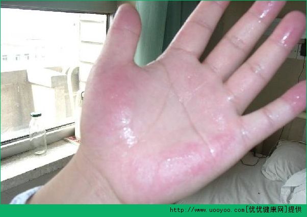 秋天手腳特別容易出汗什么原因？秋天手腳出汗怎么辦？(1)