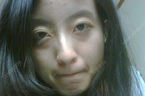 青少年有眼袋怎么辦？青少年有眼袋怎么消除？(1)