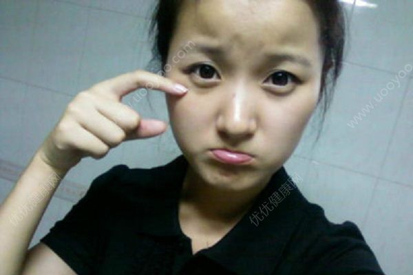 青少年有黑眼圈怎么辦？青少年黑眼圈怎么祛除？(2)