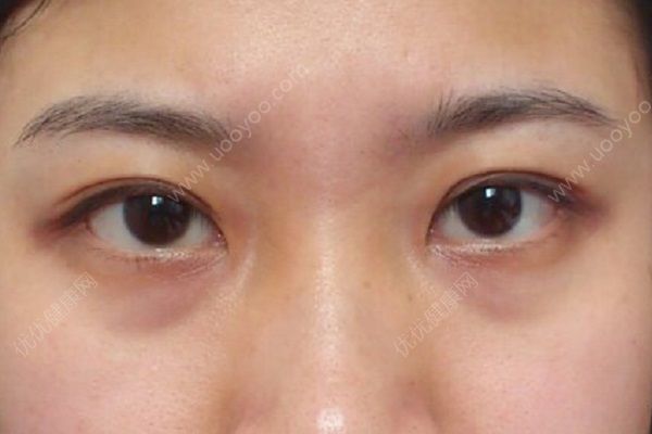 青少年有黑眼圈怎么辦？青少年黑眼圈怎么祛除？(3)