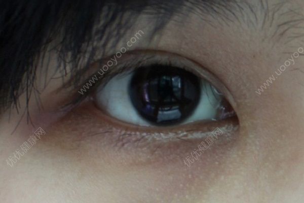 青少年有黑眼圈怎么辦？青少年黑眼圈怎么祛除？(5)