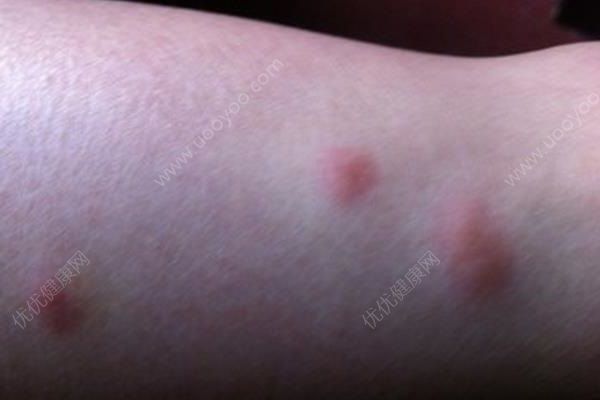 蚊子咬了很癢怎么辦？蚊子咬了為什么起包？(2)