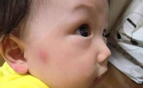 蚊子叮的癢怎么辦？蚊子叮的大包怎么辦？(1)