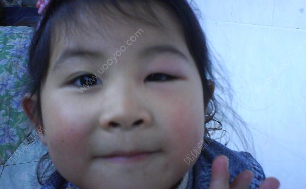 蚊子叮到眼睛怎么消除？眼睛被蚊子盯了怎么辦？(1)
