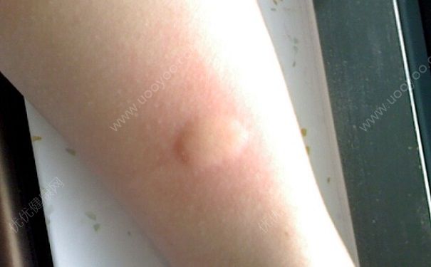 蚊子叮過為什么會腫起？蚊子咬了為什么會紅腫發(fā)癢？(1)