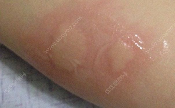 蚊子叮了會(huì)發(fā)燒嗎？蚊子叮了會(huì)不會(huì)有事？(3)
