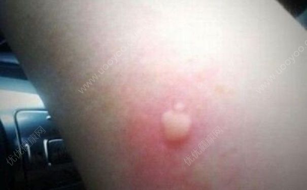 蚊子過敏怎么辦？蚊子過敏癥狀(2)