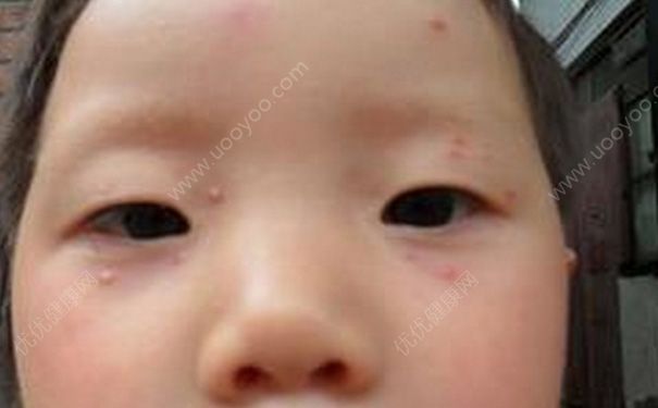 出水痘能洗澡嗎？出水痘洗澡了怎么辦？(3)