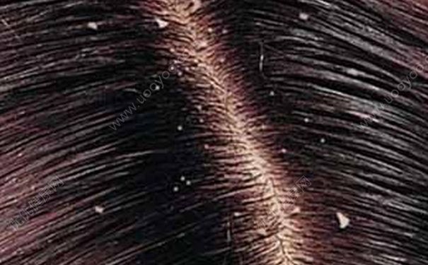 發(fā)根有白色顆粒怎么辦？發(fā)根的白點是怎么回事？(1)