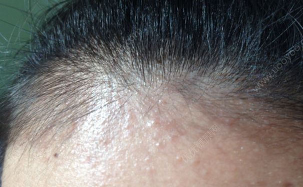發(fā)根有白色顆粒怎么辦？發(fā)根的白點是怎么回事？(4)