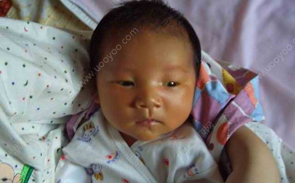 青少年黃疸癥狀有哪些？青少年黃疸怎么治？(1)