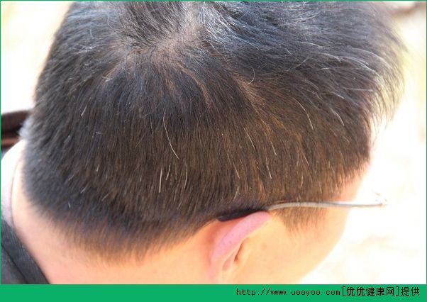 長白頭發(fā)是什么原因？吃什么能變黑？(1)