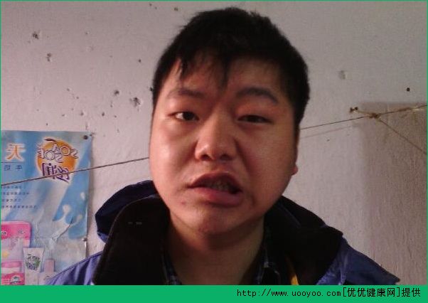 面癱是怎么回事？得了面癱該怎么治療?(1)