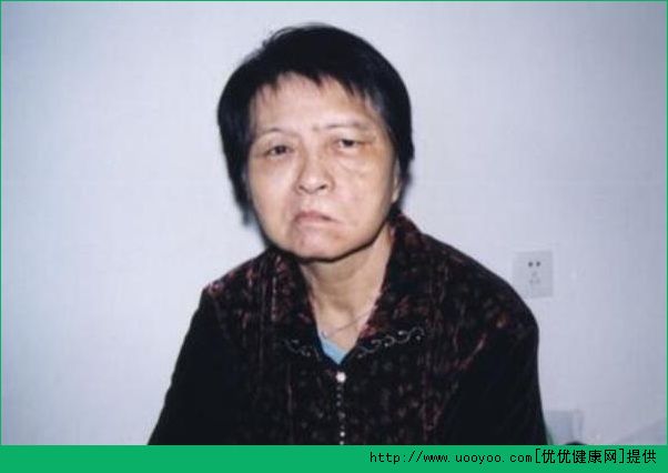 面癱是怎么回事？得了面癱該怎么治療?(4)