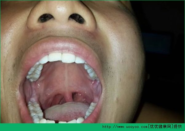 喉癌全切手術(shù)后怎么調(diào)理？喉癌全切手術(shù)后吃什么好？(1)