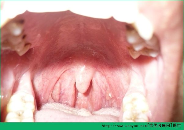 喉癌全切手術(shù)后怎么調(diào)理？喉癌全切手術(shù)后吃什么好？(5)