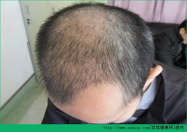 脫發(fā)的癥狀有哪些？男性脫發(fā)的表現(xiàn)是什么？(1)