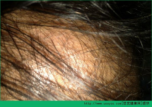 脫發(fā)的癥狀有哪些？男性脫發(fā)的表現(xiàn)是什么？(4)