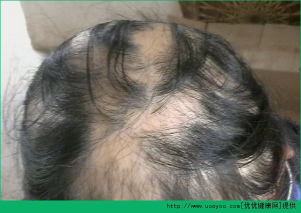 斑禿脫發(fā)有哪些癥狀？斑禿脫發(fā)的表現(xiàn)是什么？(4)