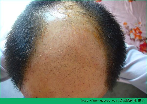 男性脫發(fā)是什么原因？男性脫發(fā)是什么引起的？(1)