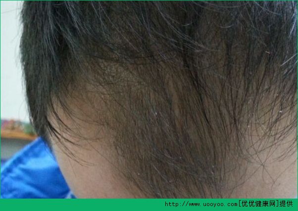 男性脫發(fā)是什么原因？男性脫發(fā)是什么引起的？(3)