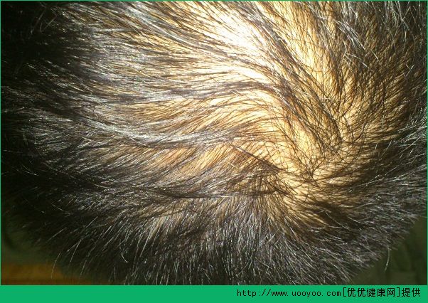 男性脫發(fā)是什么原因？男性脫發(fā)是什么引起的？(4)