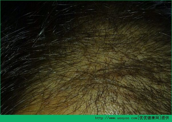 男性脫發(fā)是什么原因？男性脫發(fā)是什么引起的？(6)