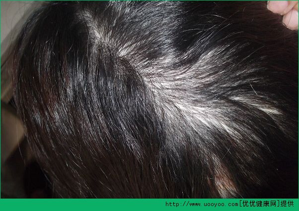 男性脫發(fā)是腎虛嗎？男性脫發(fā)與腎有何關(guān)聯(lián)？(3)
